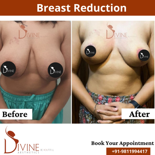 reduce breast size before after