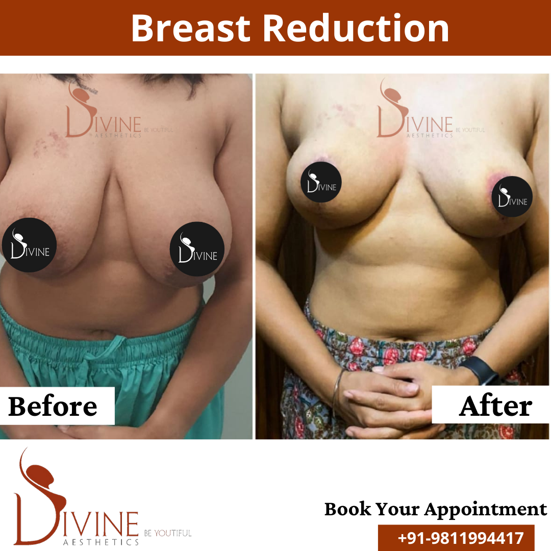Breast Reduction Cost in Delhi