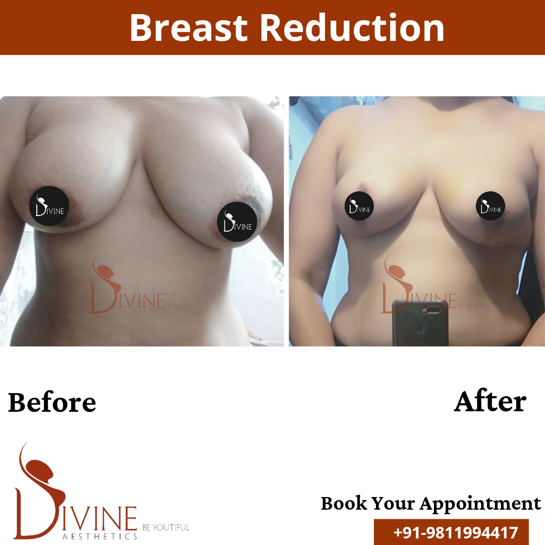 Breast Reduction Doctor in Delhi