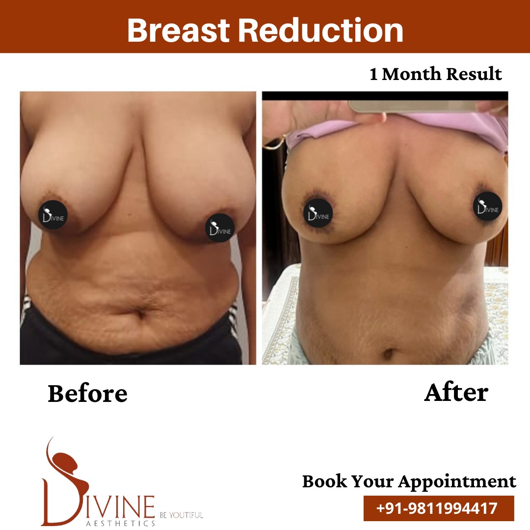 Breast Reduction before after 1 March 2022