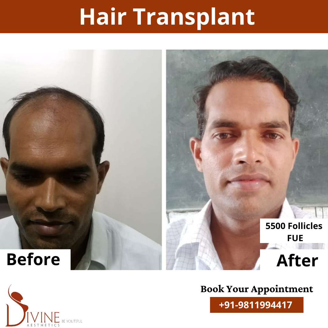 FUE Hair Transplant before after result