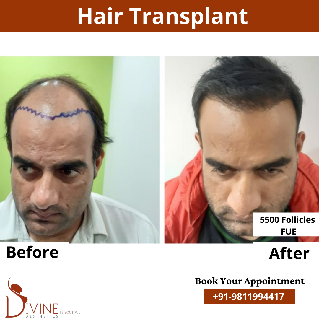 FUE Hair Transplant before after result