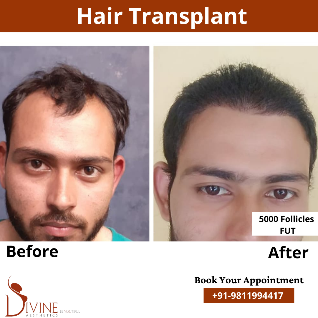 FUT Hair Transplant before after result
