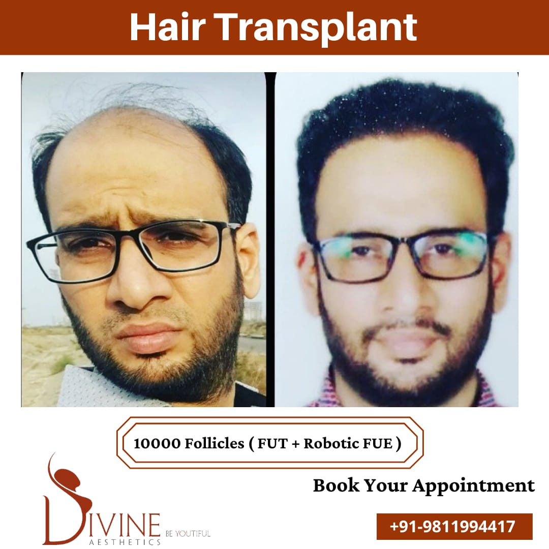 10000 Follicles - FUT+FUE hair transplant result