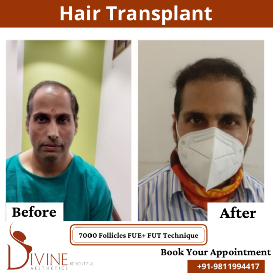 FUT+FUE Hair Transplant before after result