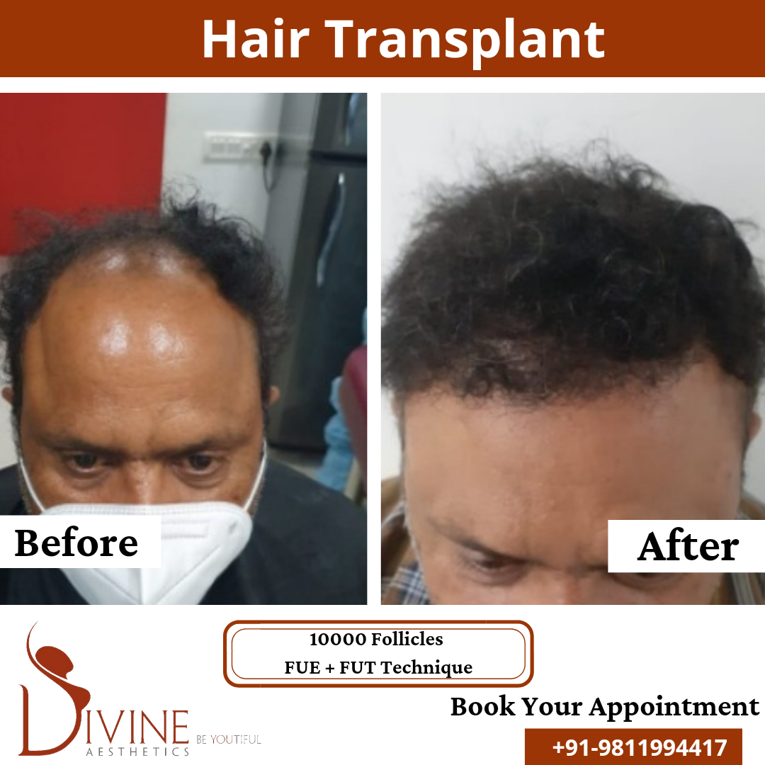 10000 Follicles - Curly hair transplant result