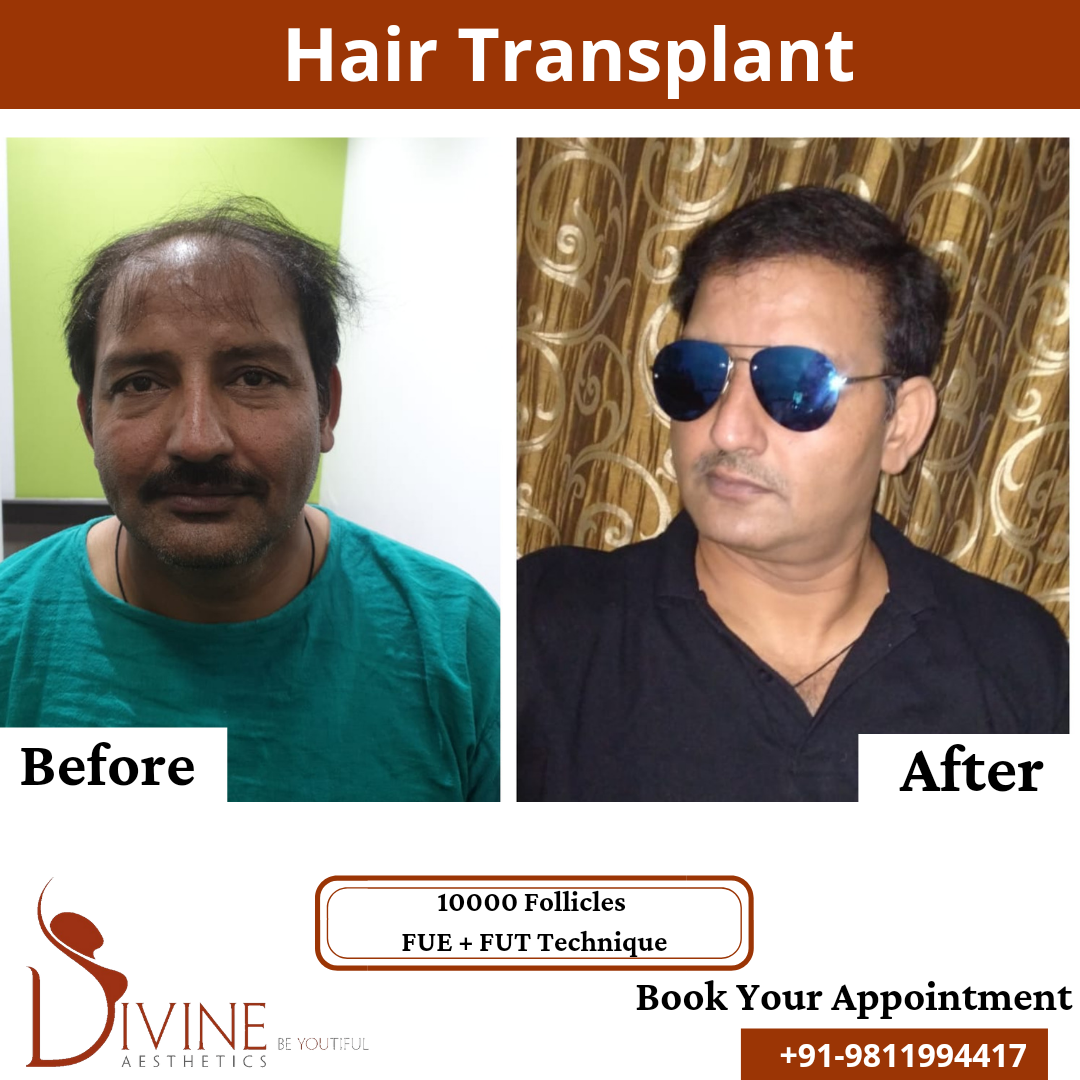 FUT+FUE Hair Transplant before after result