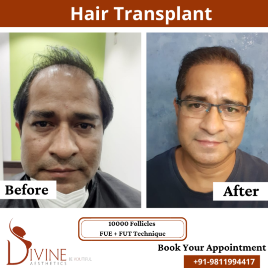 10000 Follicles -FUT+FUE hair transplant result