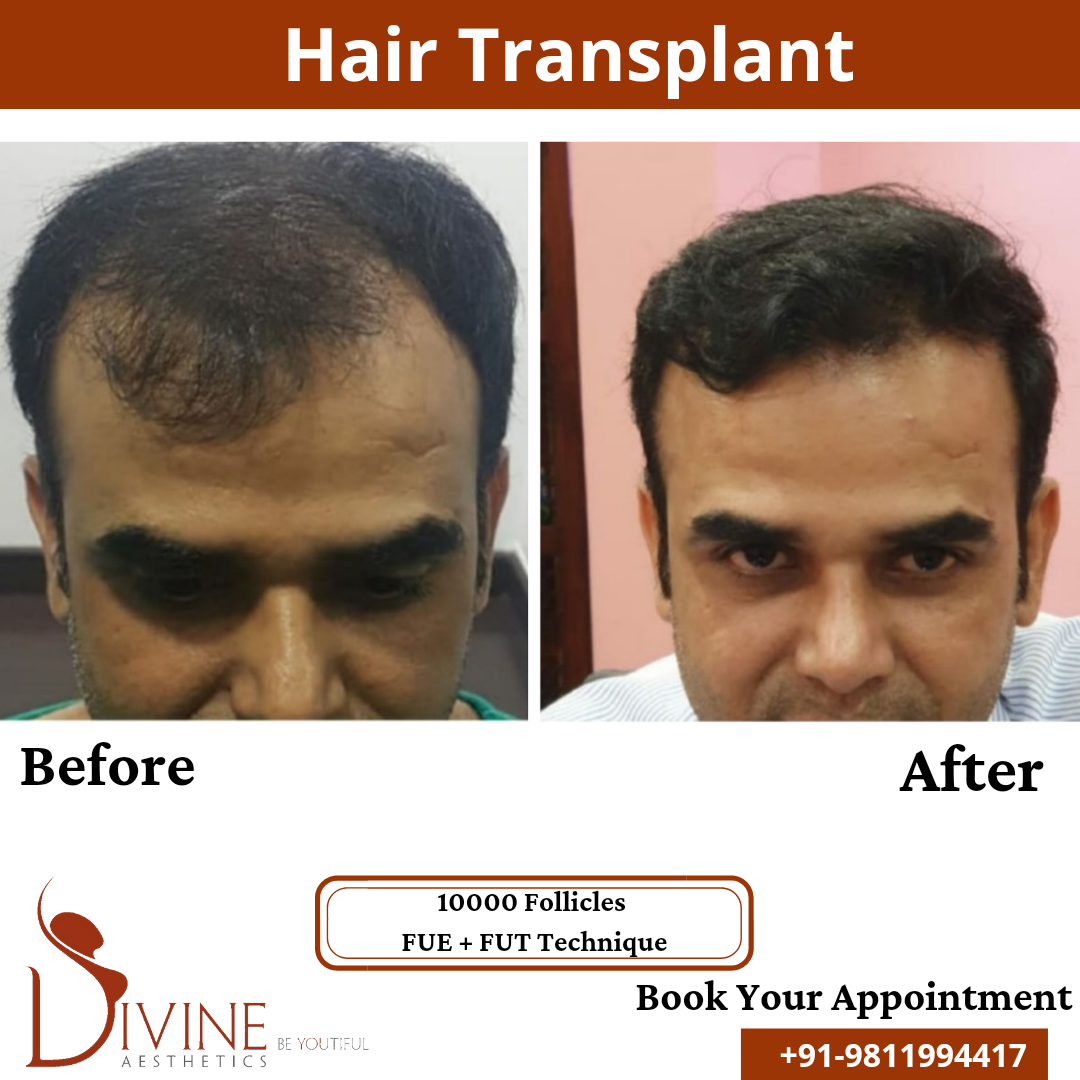 FUE Hair Transplant before after result 20