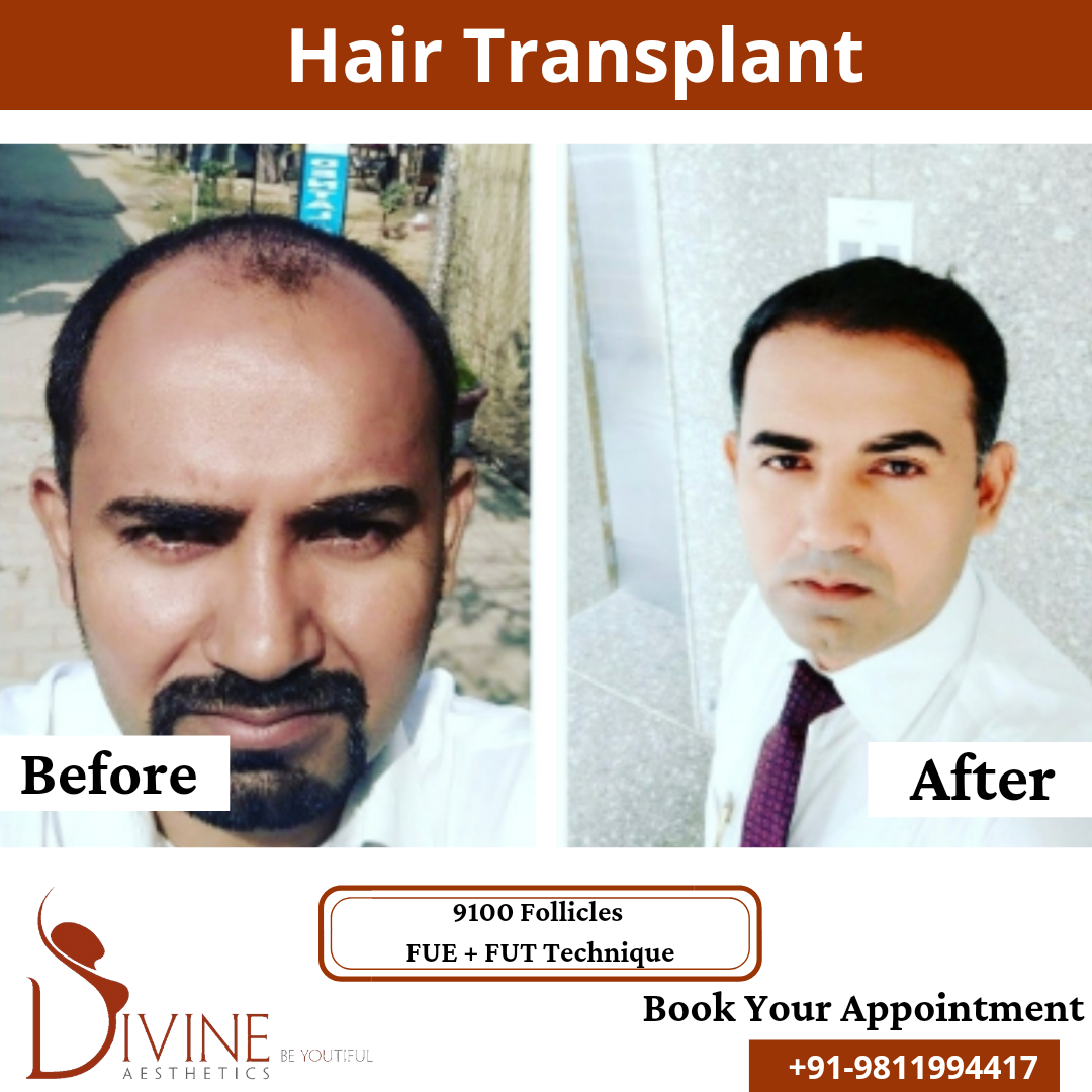 FUT+FUE Hair Transplant before after result 21