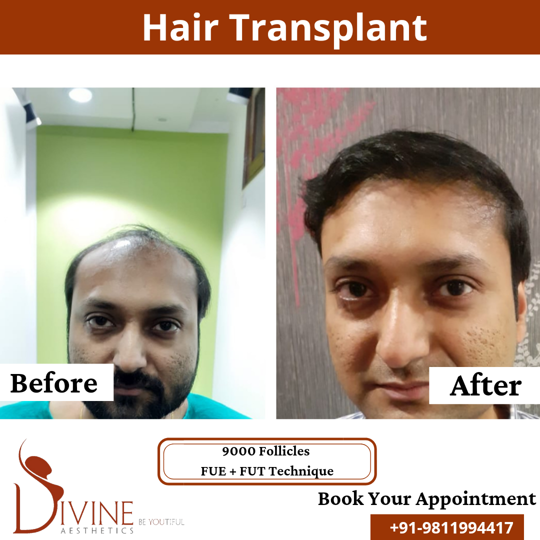 FUT+FUE Hair Transplant 22