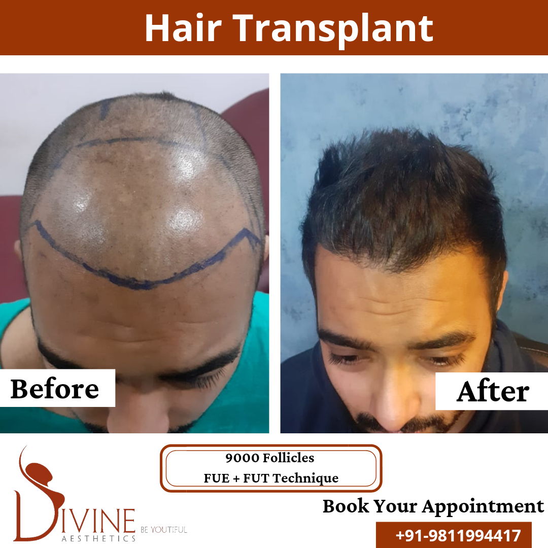 FUT+FUE Hair Transplant 23