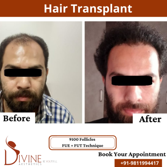 9000 Follicles - Curly hair transplant result