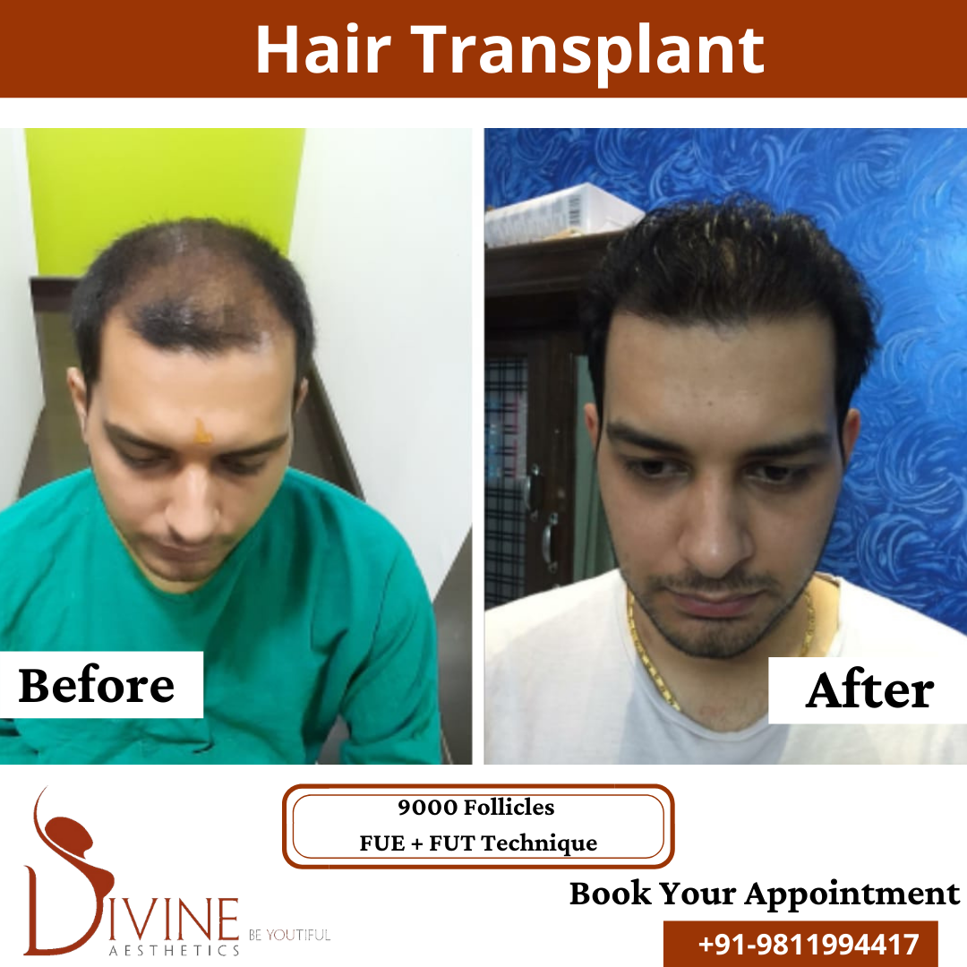 9000 Follicles - FUT+FUE hair transplant result