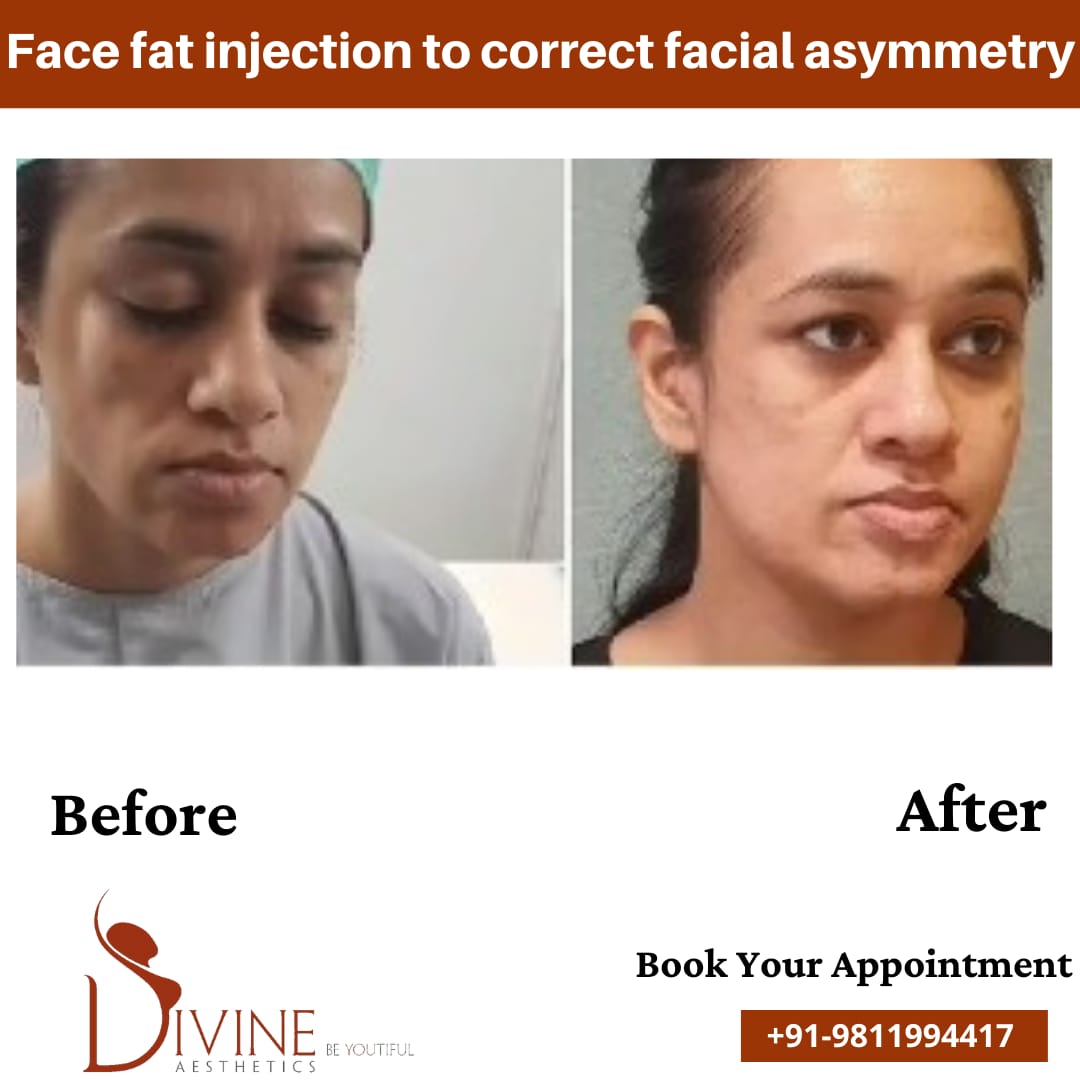 Face Fat Injection 3