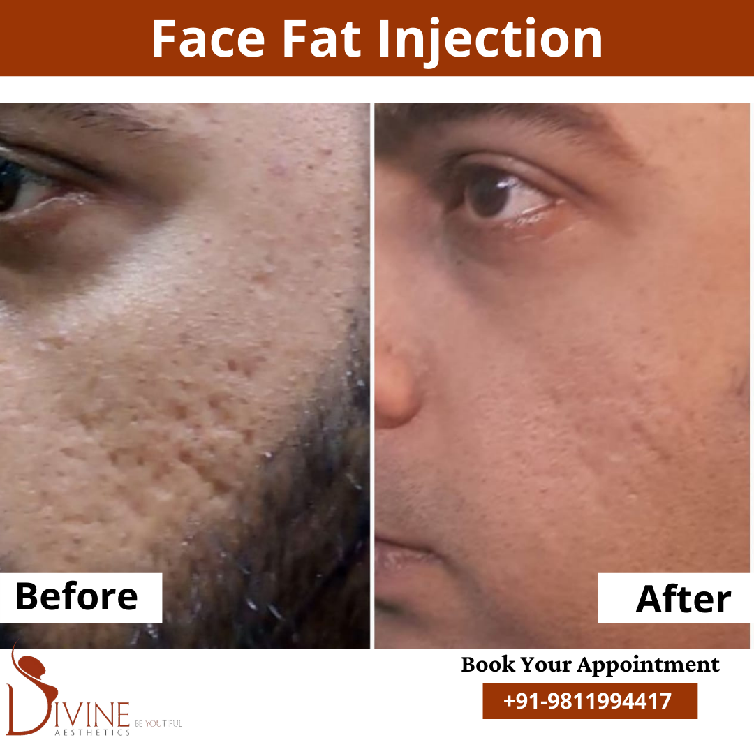 Face Fat Injection