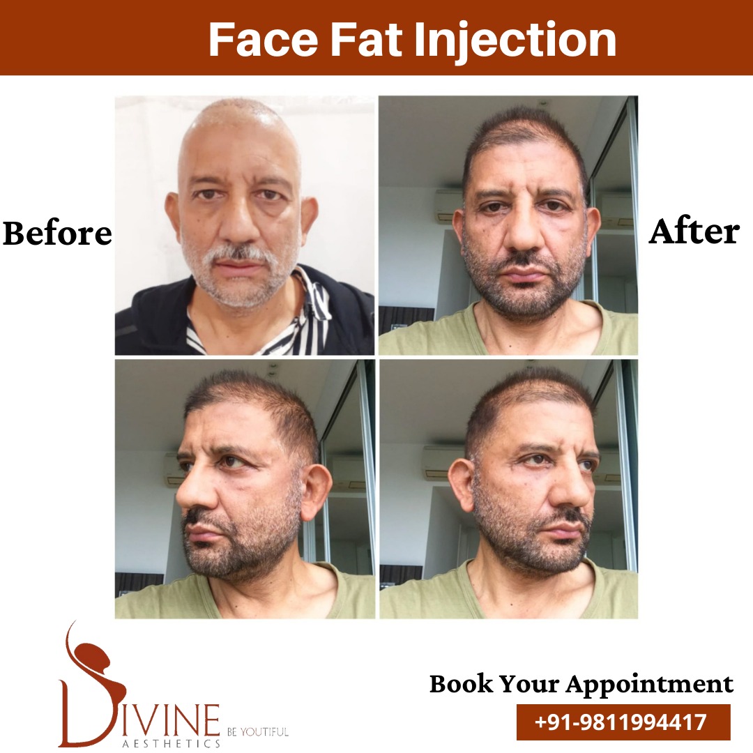 Face fat Injection March 2022