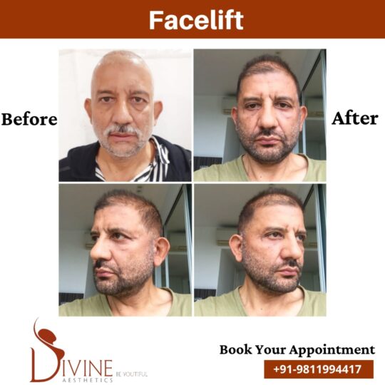 Mini facelift before After pictures