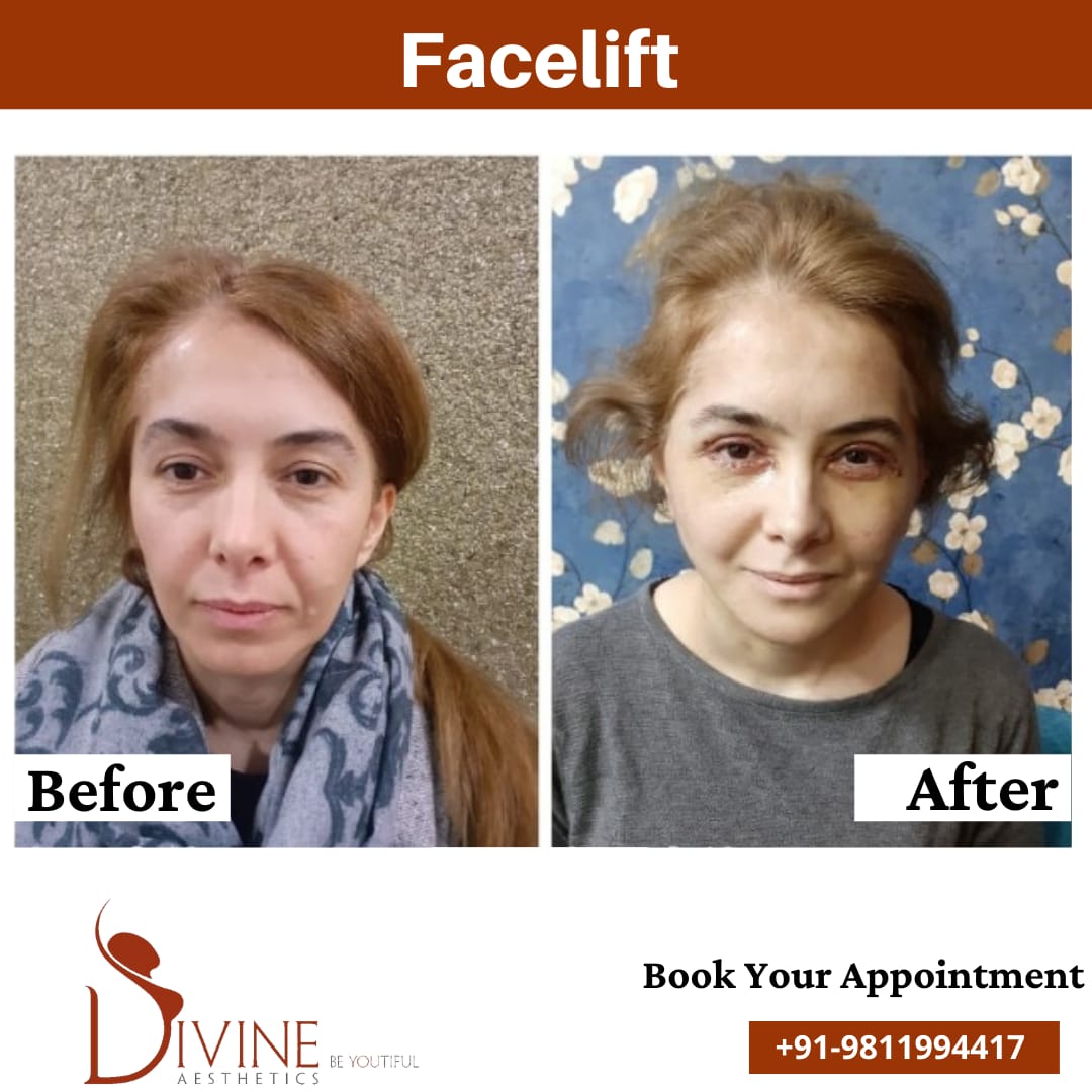 Facelift before After results Front