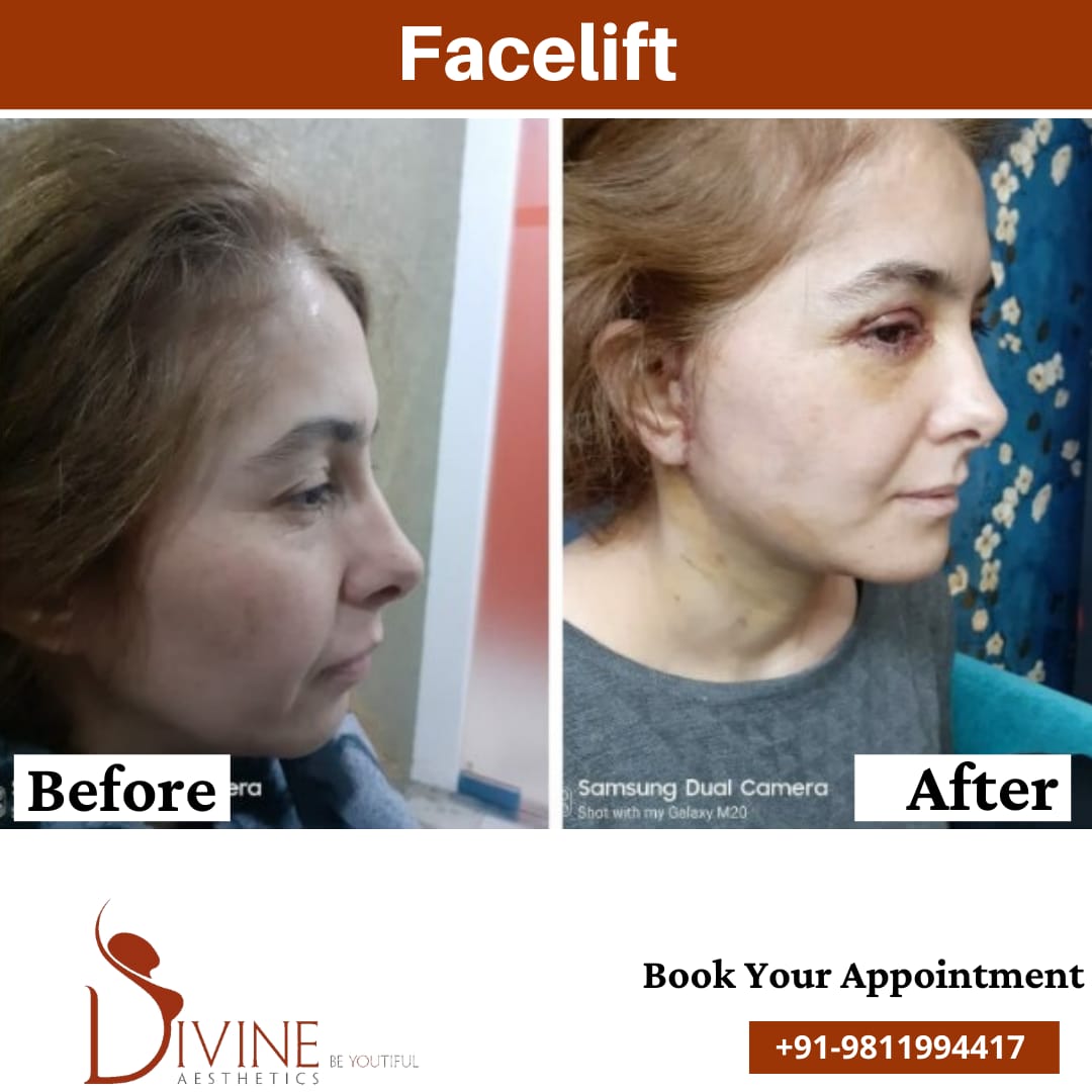 Facelift before After results Side