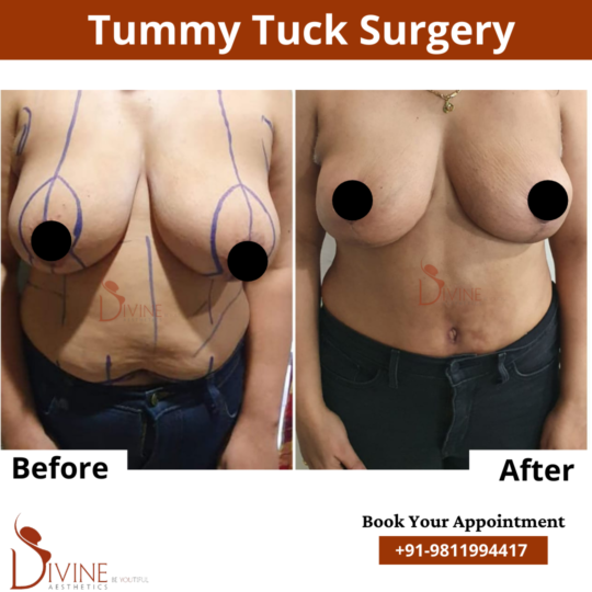 Female Abdominoplasty Surgery Result
