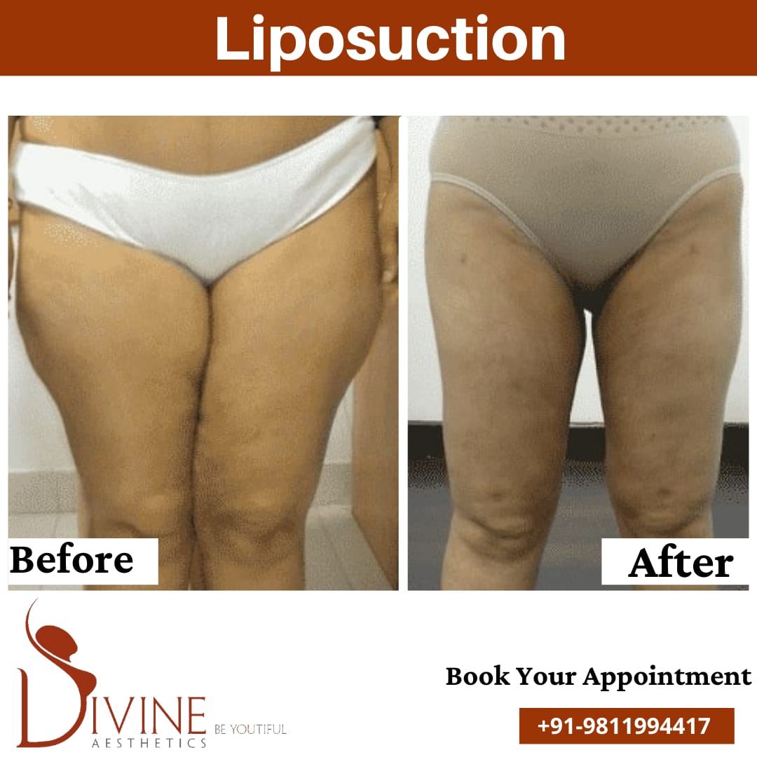 Vaser thigh liposuction before after