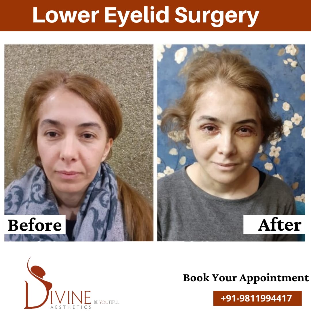 Front Lower Eyelid Surgery Before After