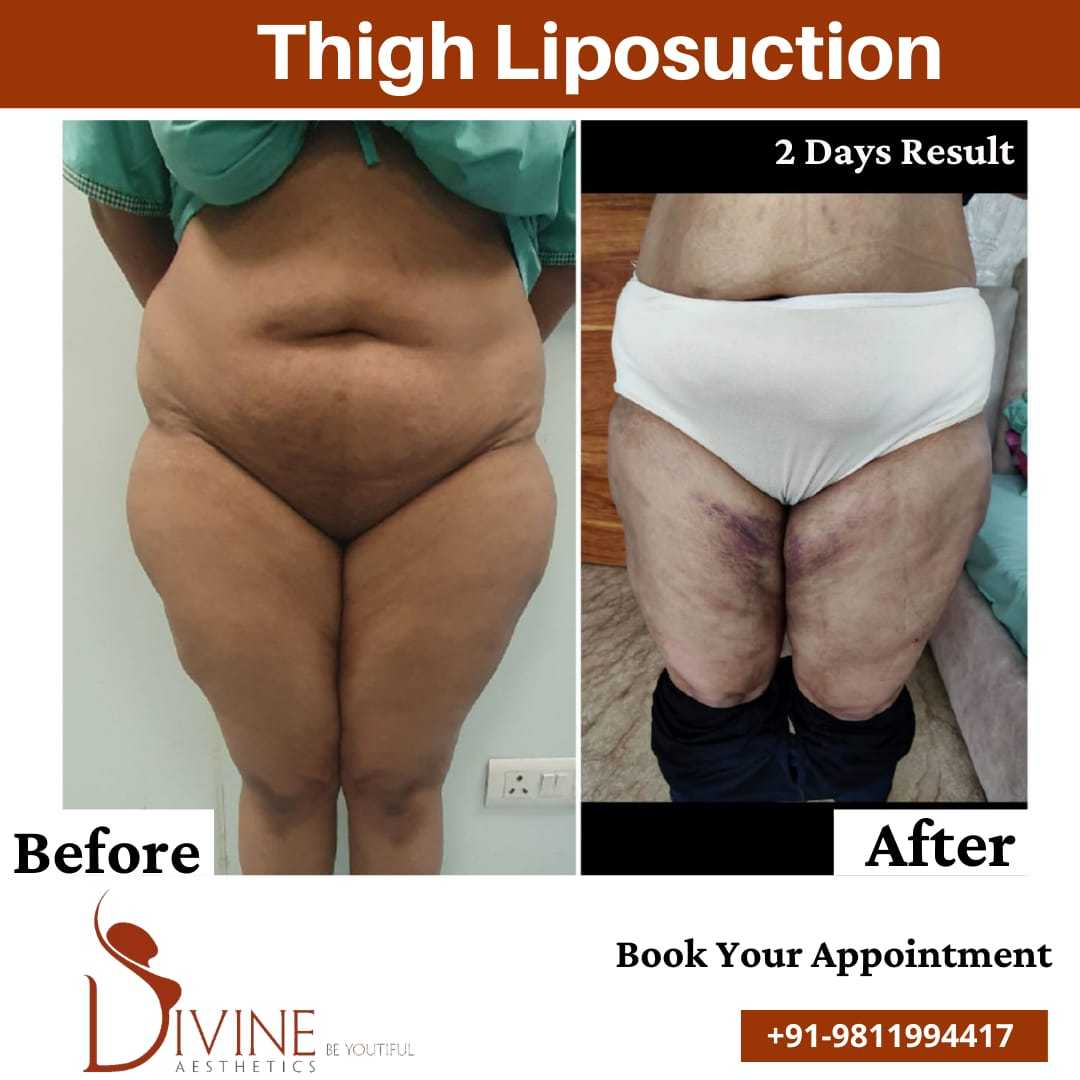 Vaser thigh liposuction before after
