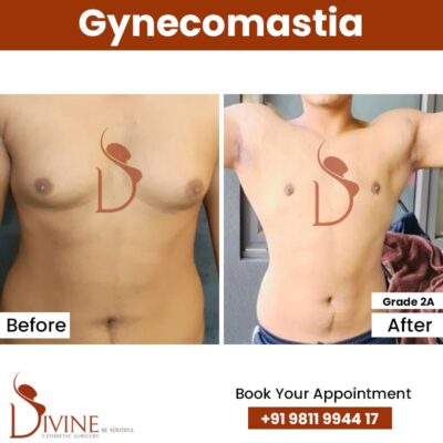 Grade 2 A - Gynecomastia Result