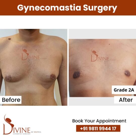 Grade 2a gynecomastia before after results