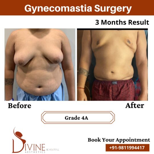 Grade 4a - Gynecomastia Result