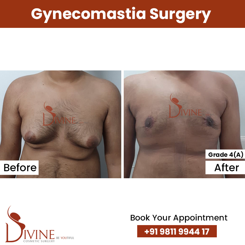 Grade 4a gynecomastia before after results