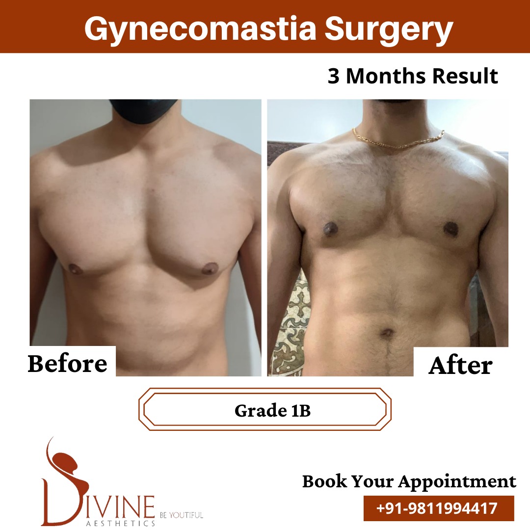 Grade 1b gynecomastia before after results