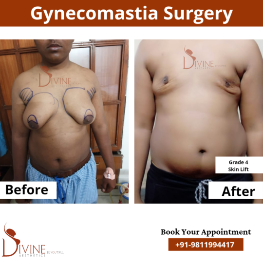 Gynecomastia Surgery Grade 4A