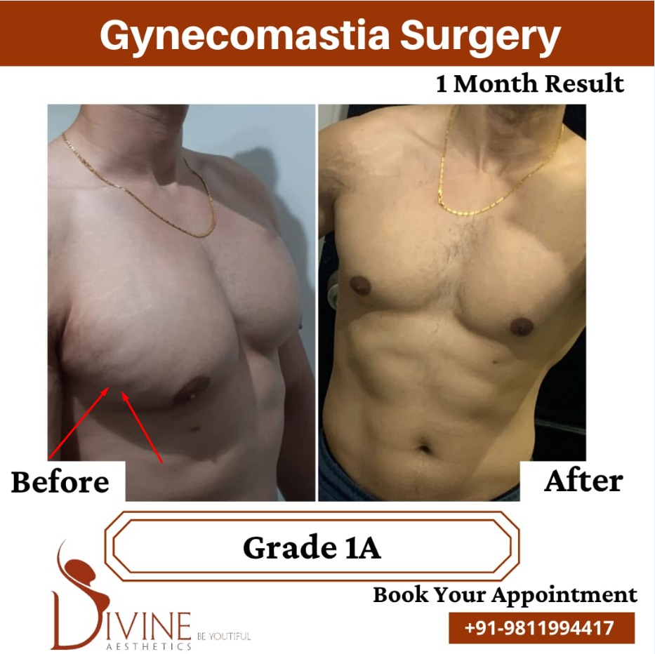 Gynecomastia surgery by Dr Amit Gupta Dec 1