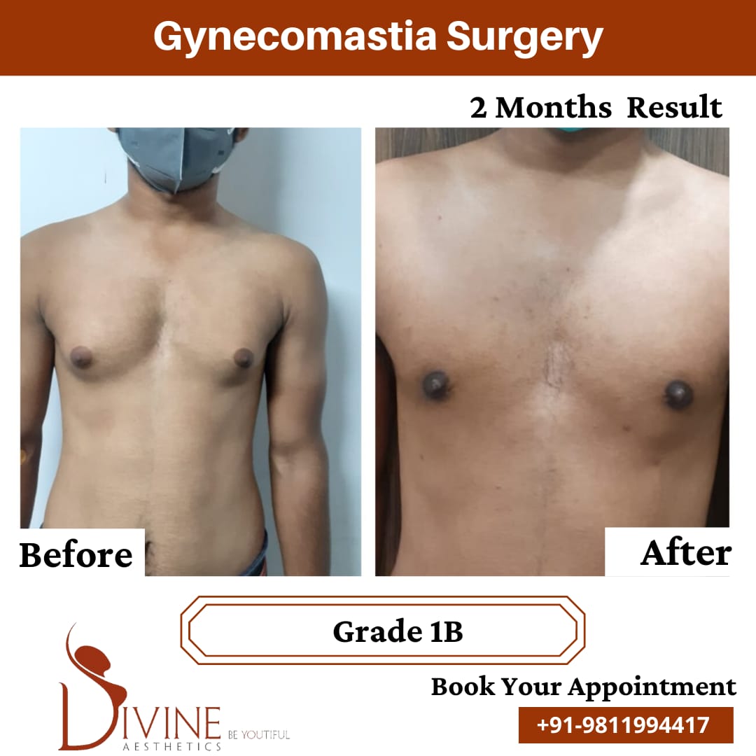 Gynecomastia surgery by Dr Amit Gupta Dec 7