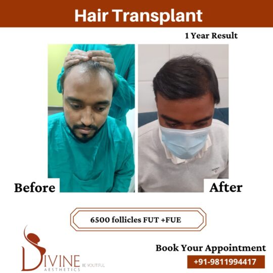Hair Transplant Before After 1 Feb 22
