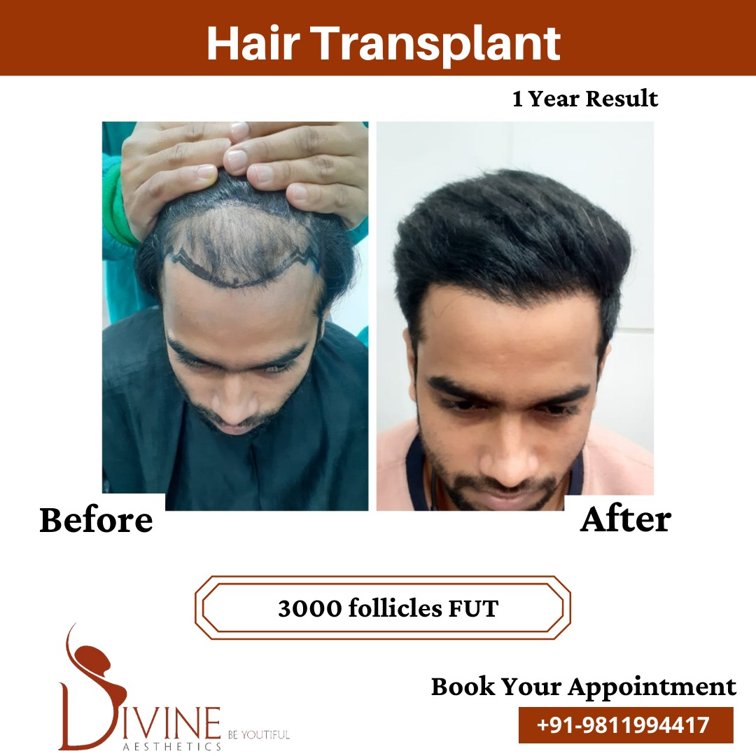 3000 follicles Hair Transplant before after result