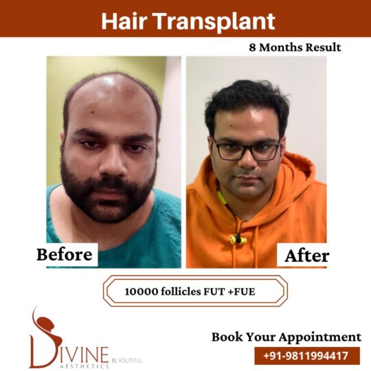 Hair Transplant Before After 3 Feb 22