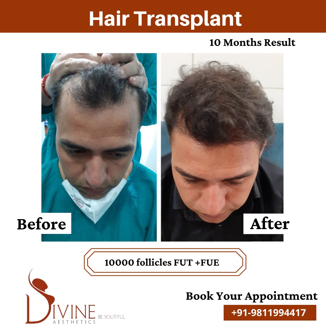 Hair Transplant Before After 4 Feb 22