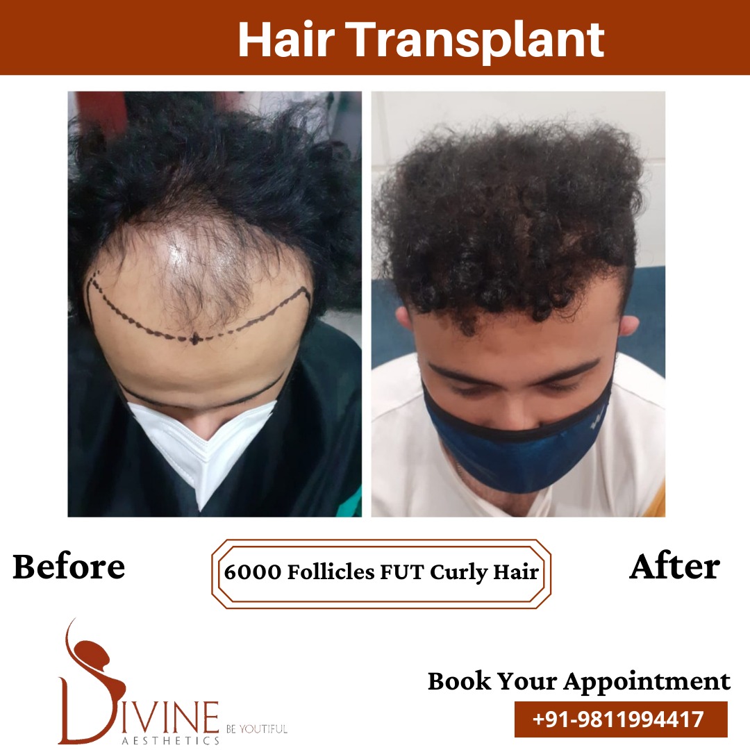 Hair Transplant Before After 5 Feb 22