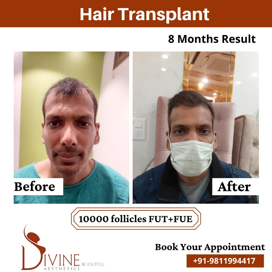 Hair Transplant Before After 6 Feb 22