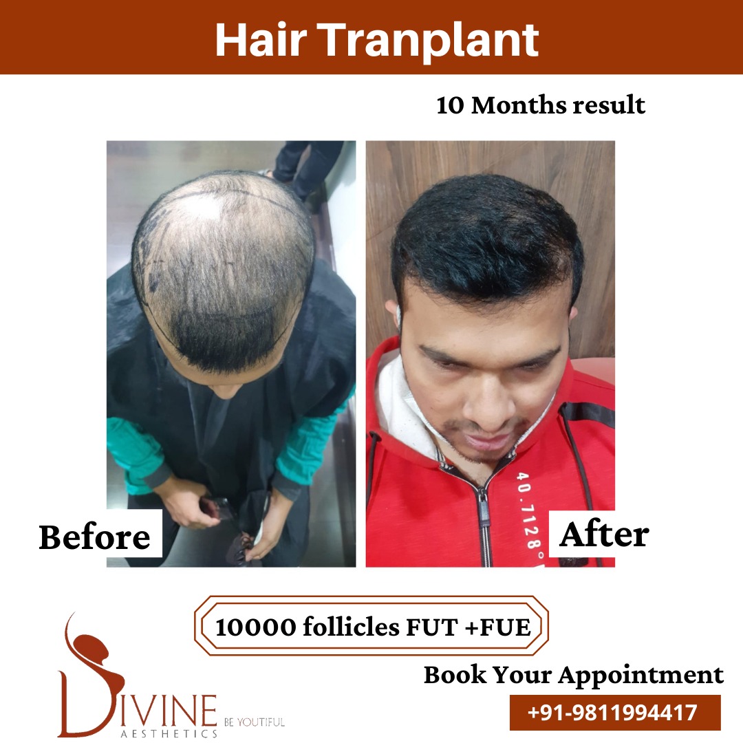 Hair Transplant Before After 7 Feb 22