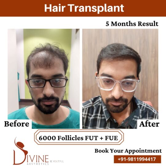 Hair Transplant by Dr Amit Gupta Dec 1