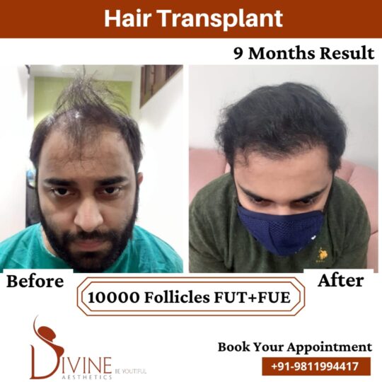 Hair Transplant by Dr Amit Gupta Dec 4