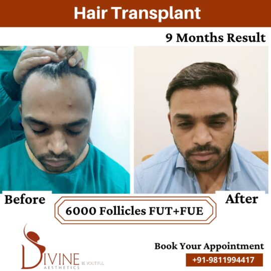 Hair Transplant by Dr Amit Gupta Dec 5