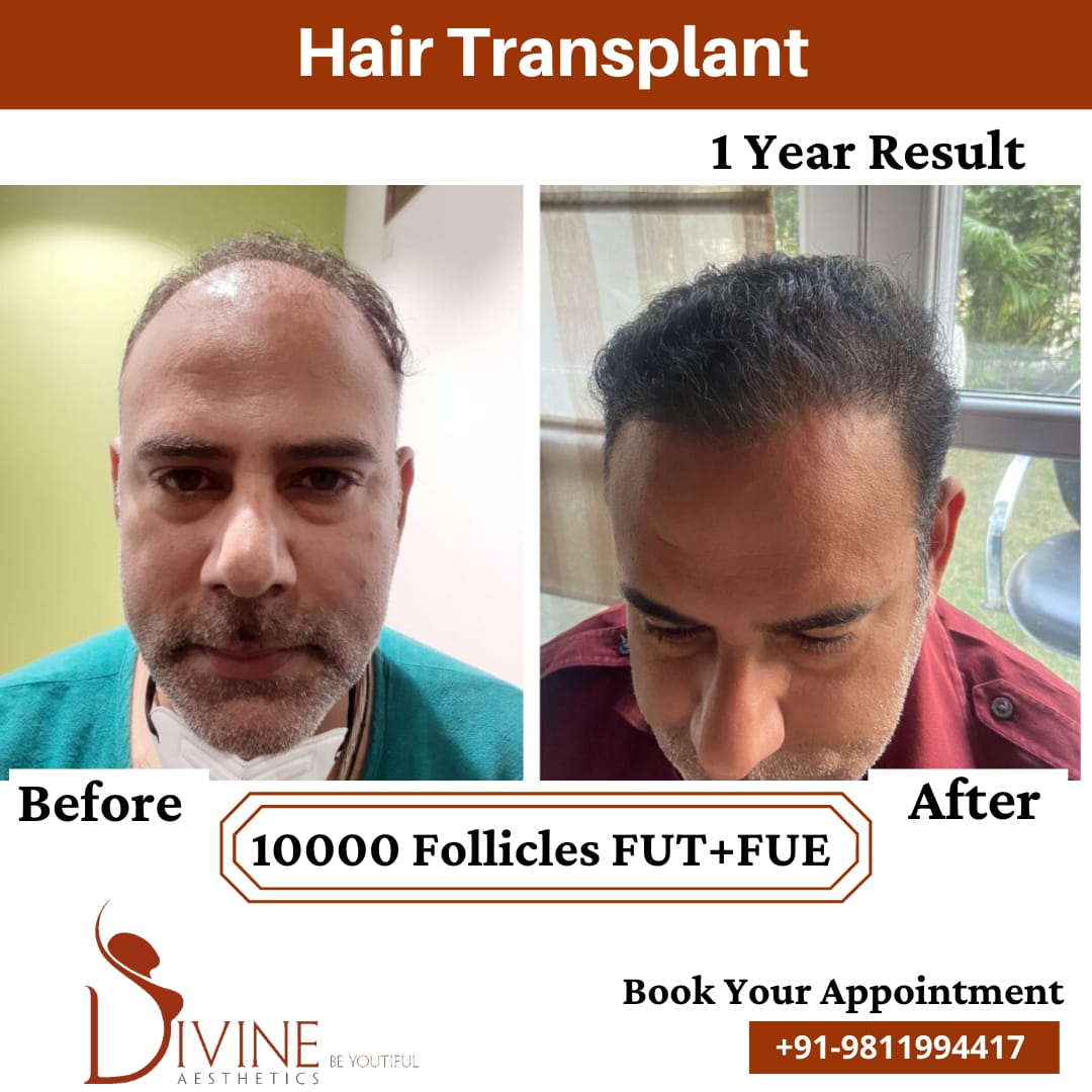 Hair Transplant by Dr Amit Gupta Dec 6