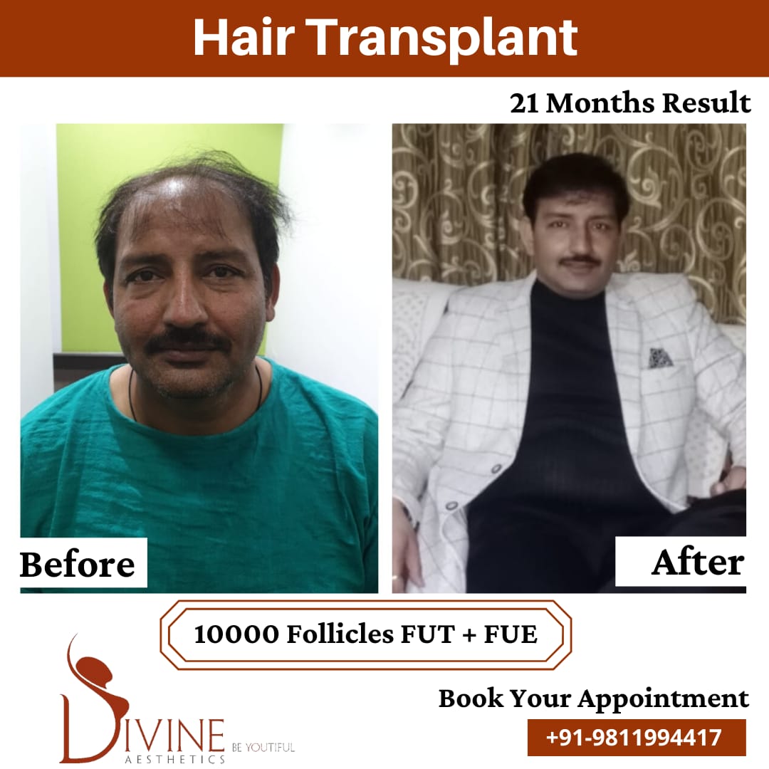 Hair Transplant by Dr Amit Gupta Dec 9