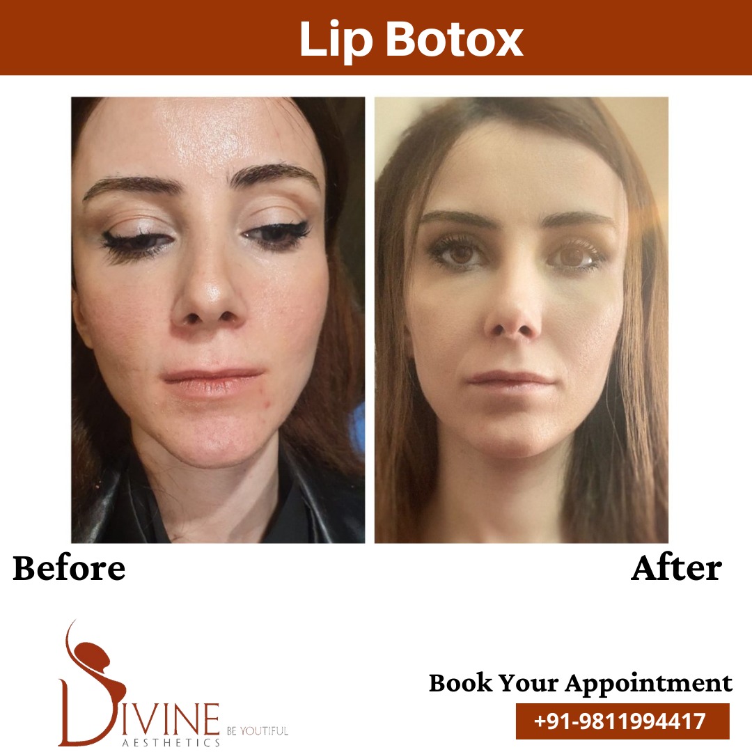 Lip Botox Before After 1 Feb 22
