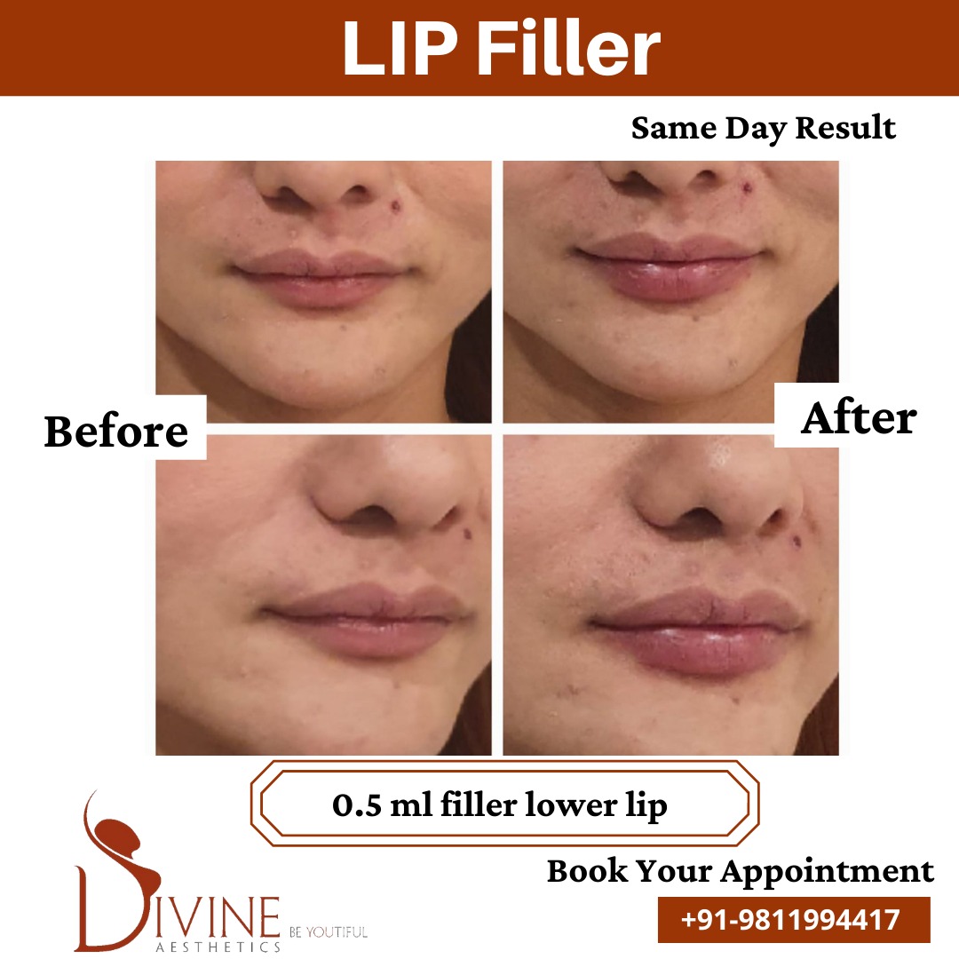 Lip - Filler Before After